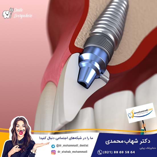بدن ما به تیتانیوم (که در پایه ایمپلنت دندان قرار دارد) حساسیت ندارد؟ - کلینیک دندانپزشکی دکتر شهاب محمدی